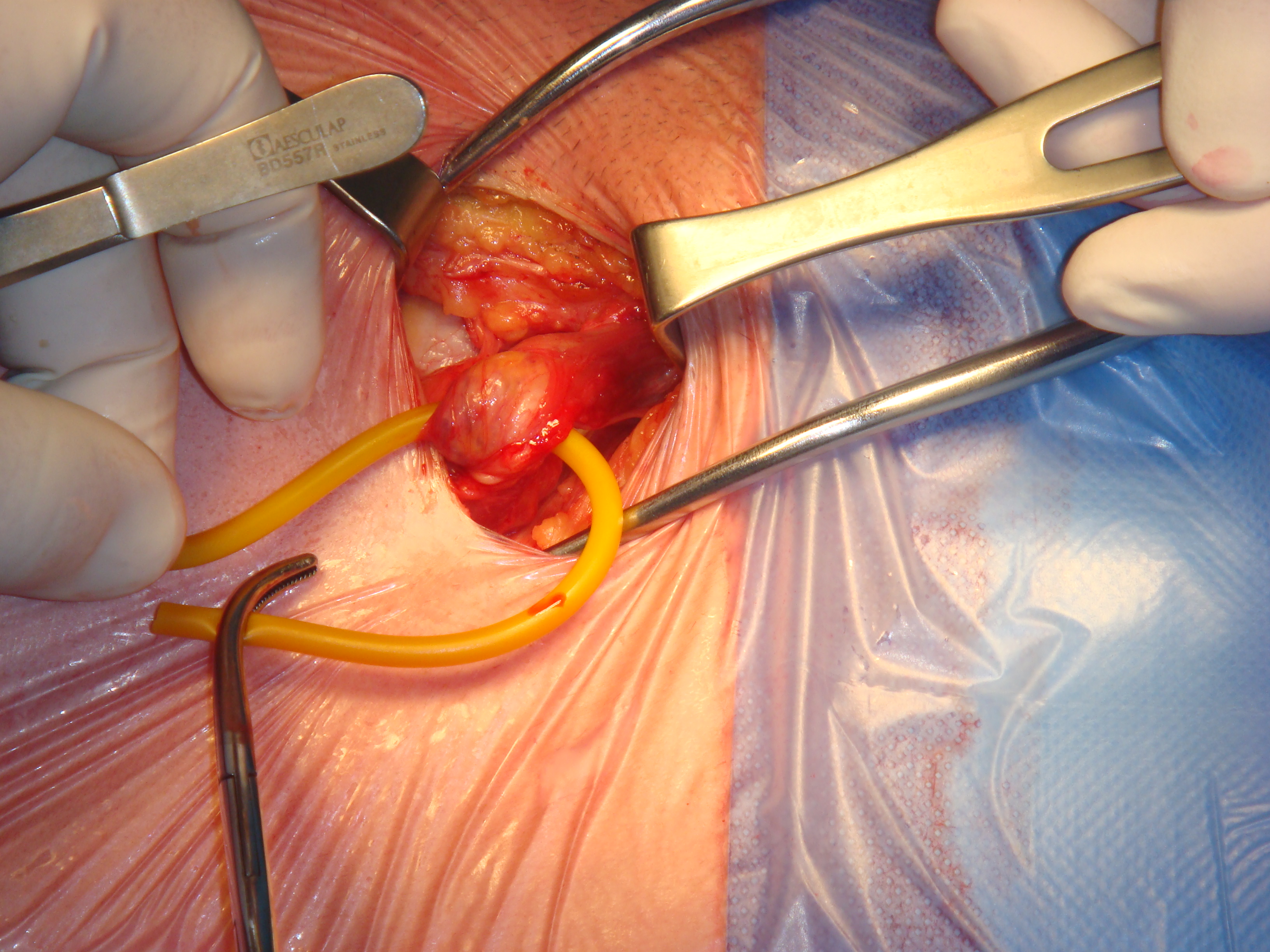  Open surgery Hernia